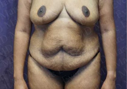 Abdominoplasty Before & After Patient #2106