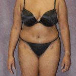 Abdominoplasty Before & After Patient #2106