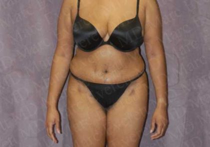 Abdominoplasty Before & After Patient #2106