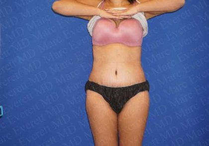 Abdominoplasty Before & After Patient #2105