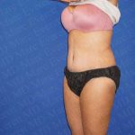 Abdominoplasty Before & After Patient #2105