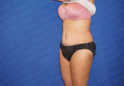 Abdominoplasty Before & After Patient #2105