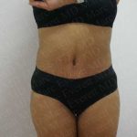 Abdominoplasty Before & After Patient #2104