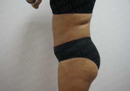 Abdominoplasty Before & After Patient #2104
