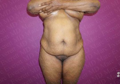 Abdominoplasty Before & After Patient #2068