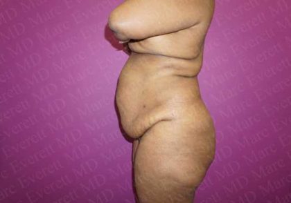 Abdominoplasty Before & After Patient #2068