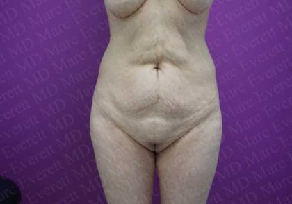 Abdominoplasty Before & After Patient #2067