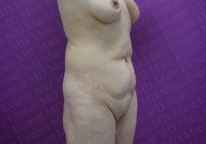 Abdominoplasty Before & After Patient #2067