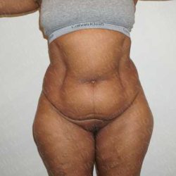 Abdominoplasty Before & After Patient #2101
