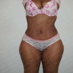 Abdominoplasty Before & After Patient #2101