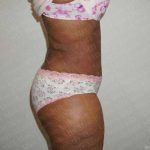 Abdominoplasty Before & After Patient #2101