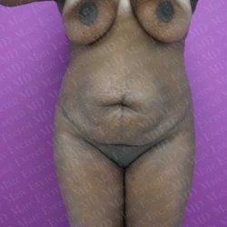 Abdominoplasty Before & After Patient #2066