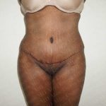 Abdominoplasty Before & After Patient #2066