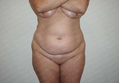 Abdominoplasty Before & After Patient #2065
