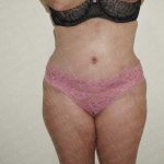 Abdominoplasty Before & After Patient #2065