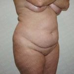 Abdominoplasty Before & After Patient #2065