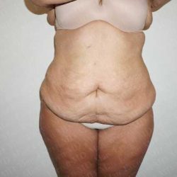 Abdominoplasty Before & After Patient #2063