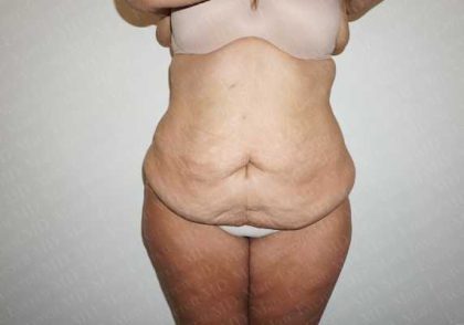 Abdominoplasty Before & After Patient #2063