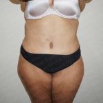 Abdominoplasty Before & After Patient #2063