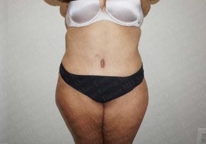 Abdominoplasty Before & After Patient #2063
