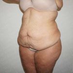 Abdominoplasty Before & After Patient #2063