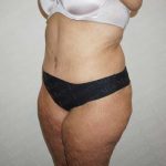 Abdominoplasty Before & After Patient #2063