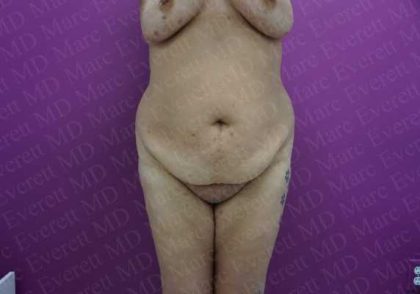 Abdominoplasty Before & After Patient #2062
