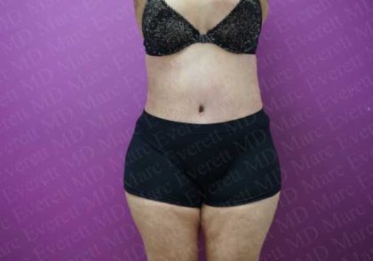 Abdominoplasty Before & After Patient #2061