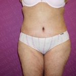 Abdominoplasty Before & After Patient #2060