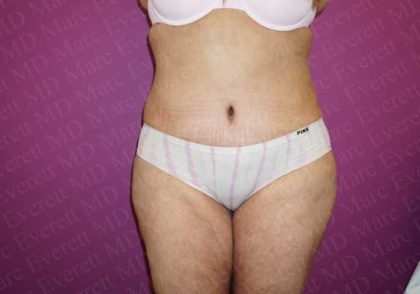 Abdominoplasty Before & After Patient #2060