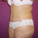 Abdominoplasty Before & After Patient #2060