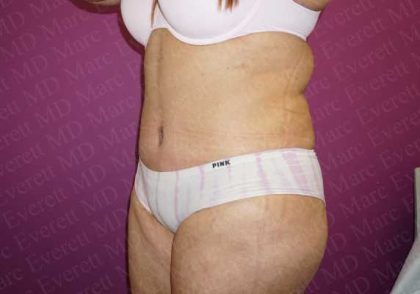 Abdominoplasty Before & After Patient #2060