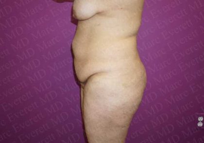 Abdominoplasty Before & After Patient #2060