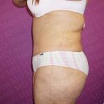 Abdominoplasty Before & After Patient #2060