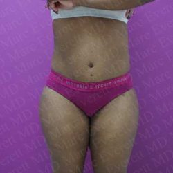Abdominoplasty Before & After Patient #2059