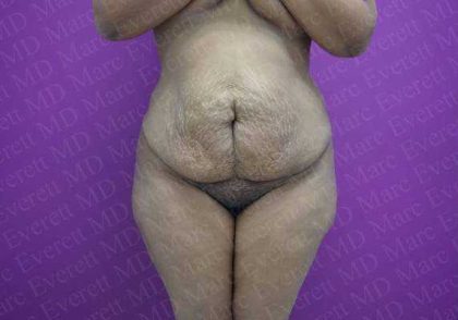 Abdominoplasty Before & After Patient #2057