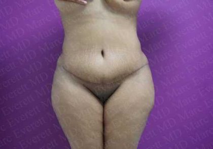 Abdominoplasty Before & After Patient #2057