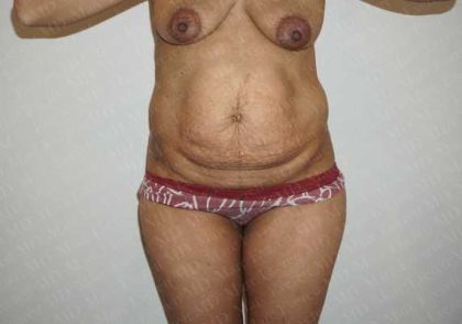 Abdominoplasty Before & After Patient #2100