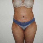 Abdominoplasty Before & After Patient #2100