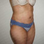 Abdominoplasty Before & After Patient #2100
