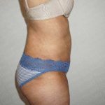 Abdominoplasty Before & After Patient #2100