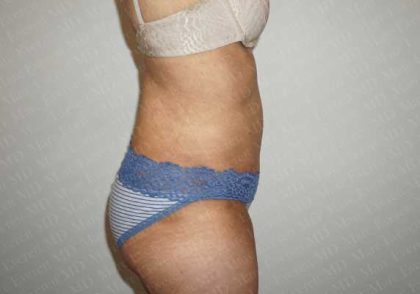 Abdominoplasty Before & After Patient #2100