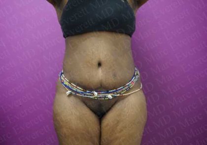 Abdominoplasty Before & After Patient #2056