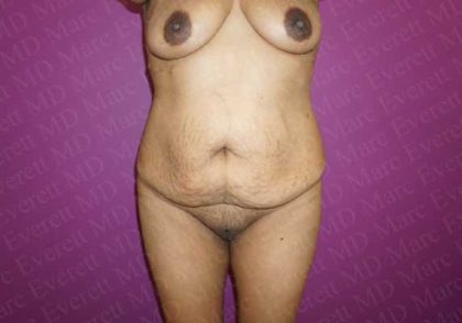 Abdominoplasty Before & After Patient #2054