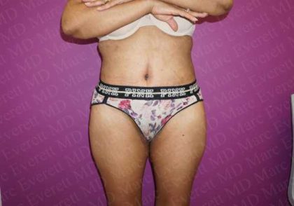 Abdominoplasty Before & After Patient #2054