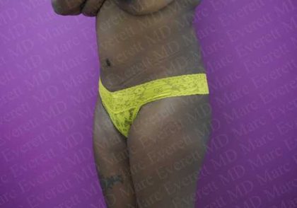 Abdominoplasty Before & After Patient #2099