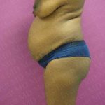 Abdominoplasty Before & After Patient #2099