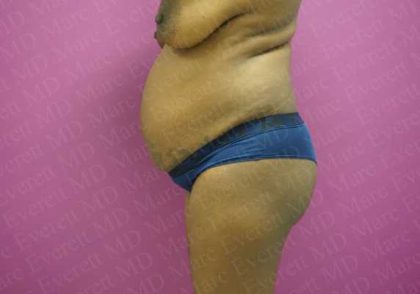 Abdominoplasty Before & After Patient #2099