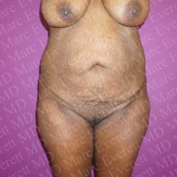 Abdominoplasty Before & After Patient #2097