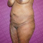 Abdominoplasty Before & After Patient #2097